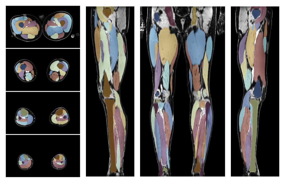 Overlay of automated muscle segmentation labels on dixon water image.