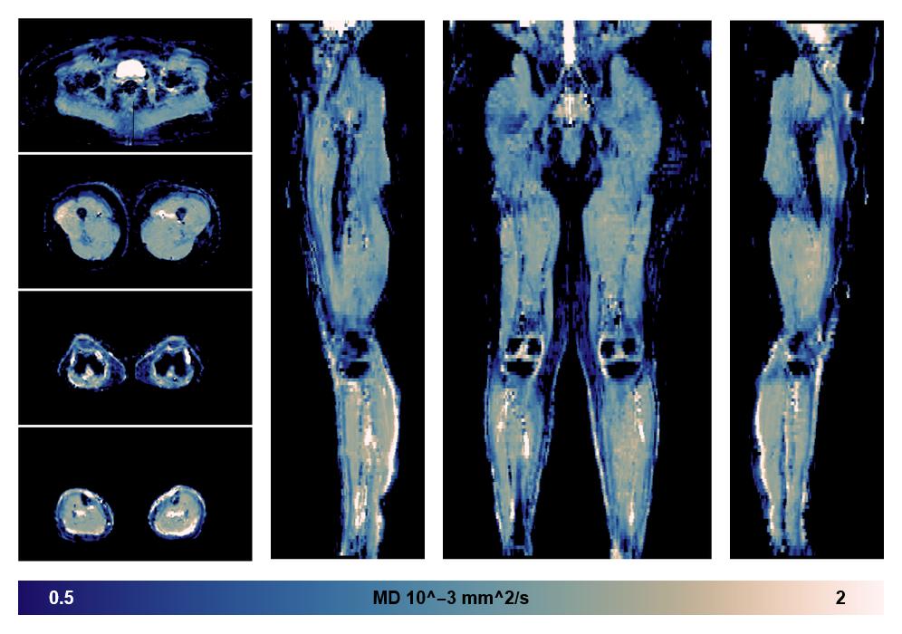 IVIM corrected whole leg muscle mean diffusivity obtained from diffusion tensor imaging.