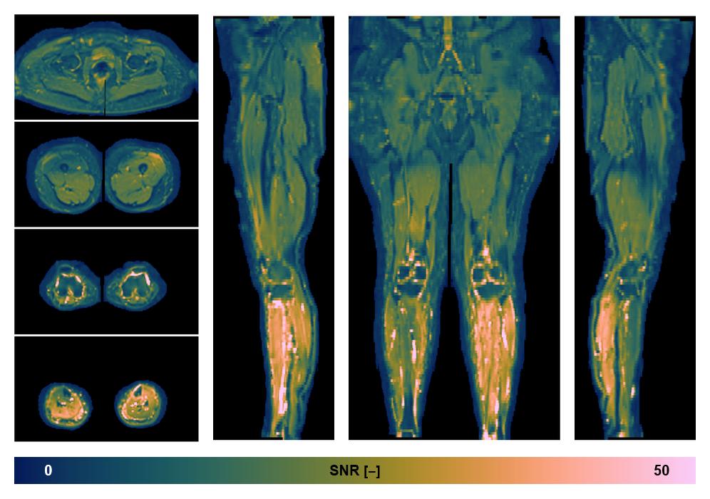 SNR distribution of the unweighted diffusion data.