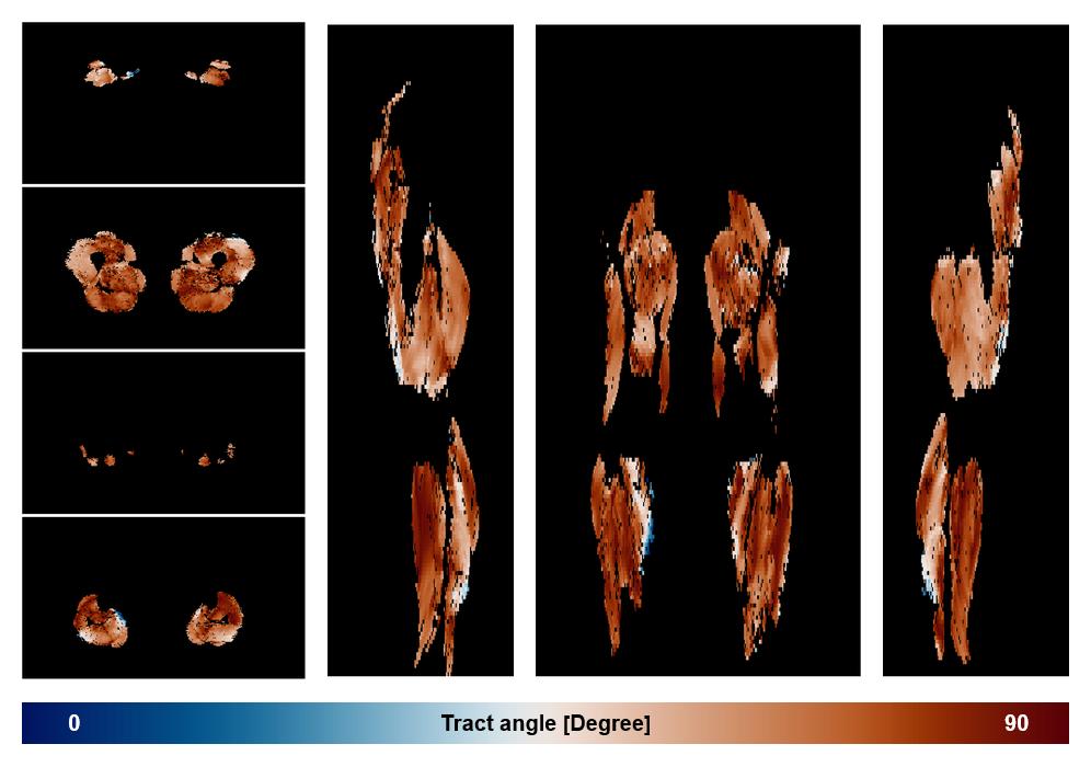 Muscle fiber tract angle map based on whole leg DTI based fiber tractography.