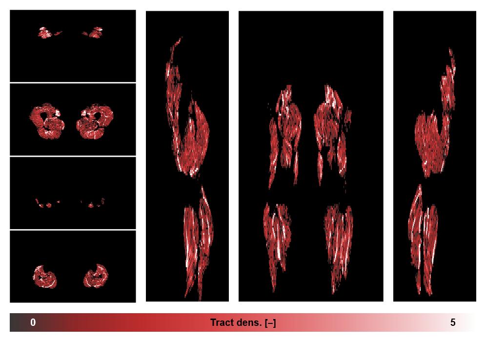 Muscle fiber tract density map based on whole leg DTI based fiber tractography.
