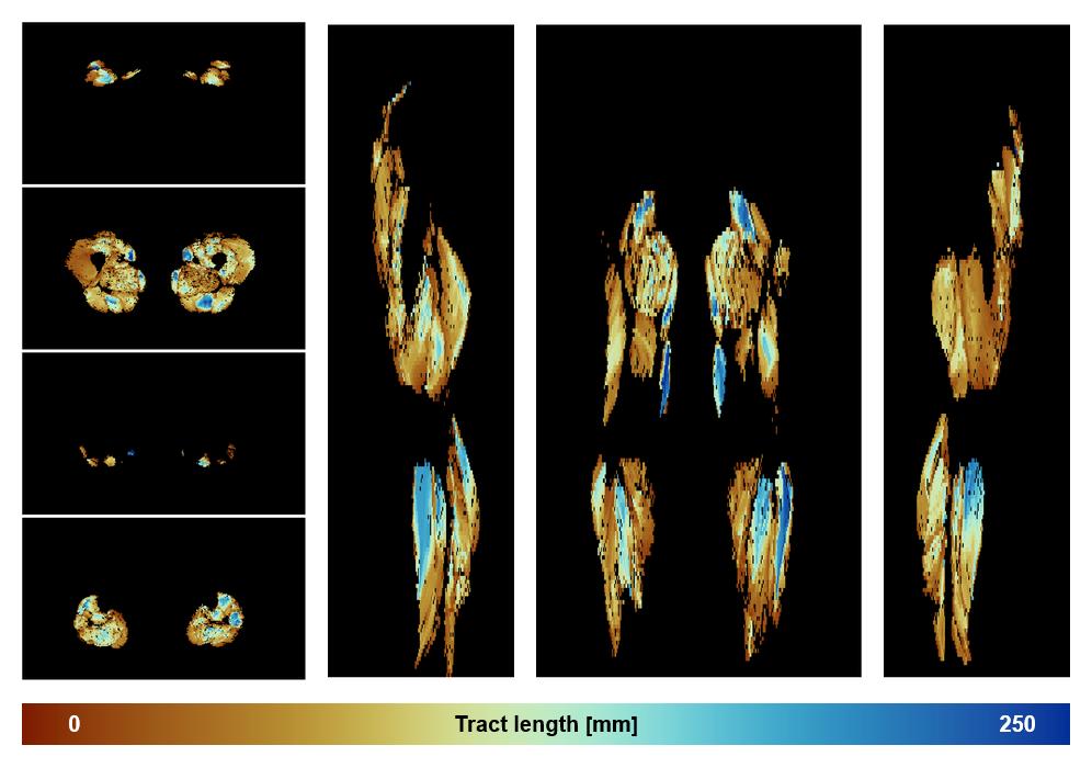 Muscle fiber tract length map based on whole leg DTI based fiber tractography.