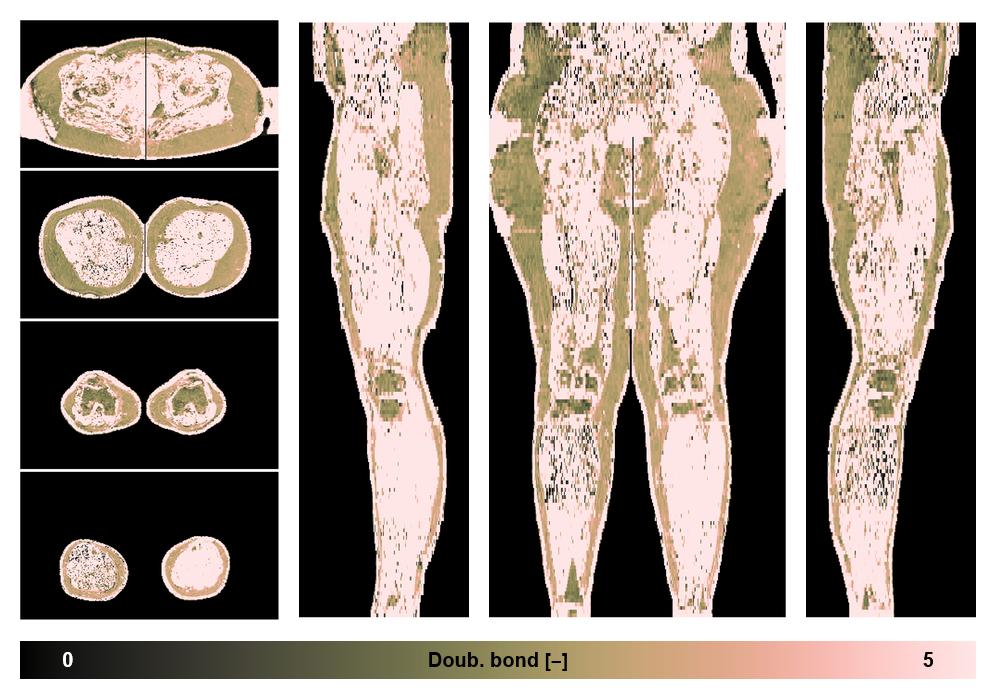 Number of double bonds in subcutanious fat.