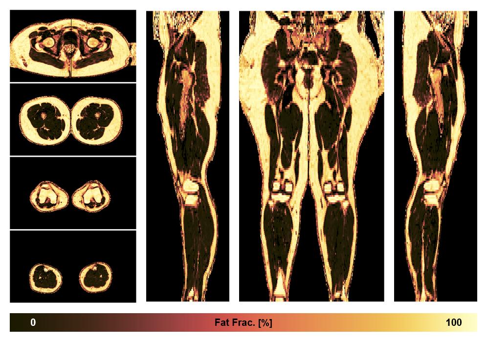 The fat fraction of the lower extremity obtained from the dixon reconstruction for muscle water fat quantification.