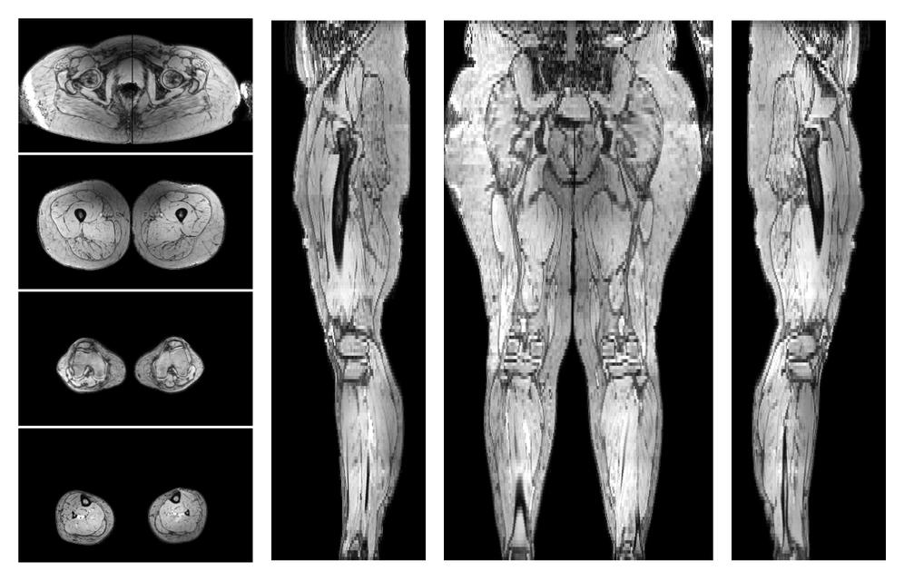 The out-phase image of the dixon reconstruction for water fat quantification.