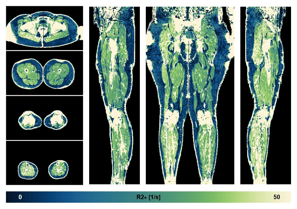 The R2 star relaxation time of the lower extremity obtained from the dixon reconstruction for muscle water fat quantification.