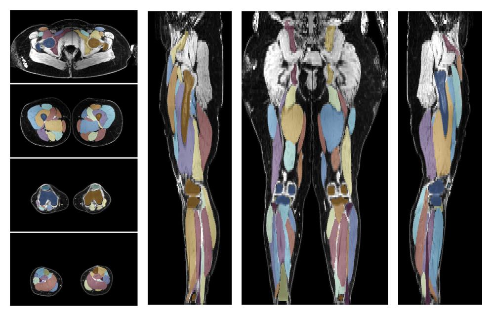 Overlay of automated muscle segmentation labels on dixon water image.