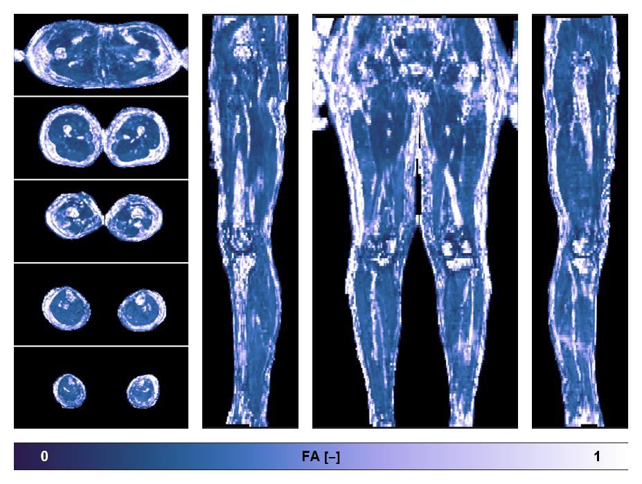 IVIM corrected whole leg muscle fractional anisotropy obtained from diffusion tensor imaging.