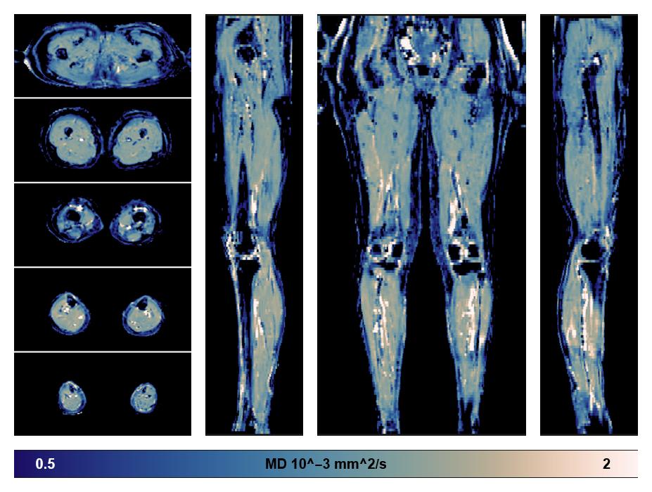 IVIM corrected whole leg muscle mean diffusivity obtained from diffusion tensor imaging.