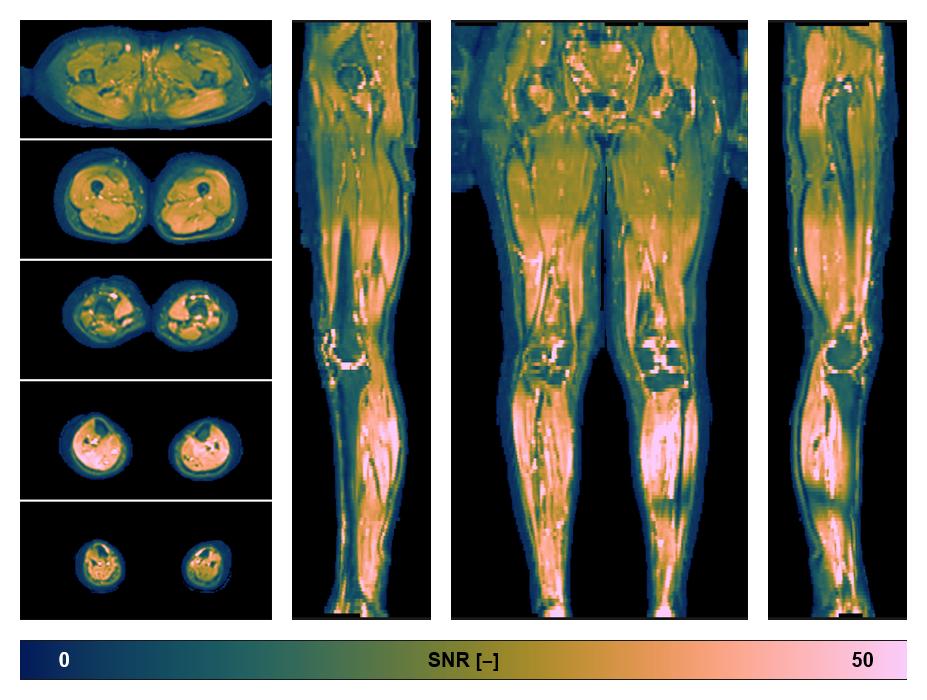 SNR distribution of the unweighted diffusion data.