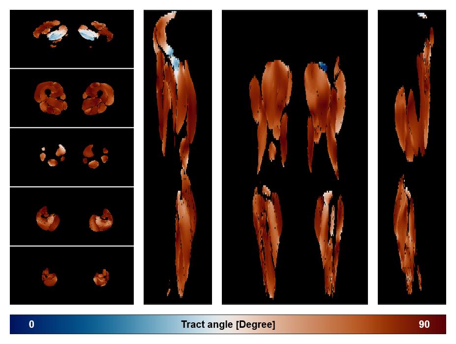 Muscle fiber tract angle map based on whole leg DTI based fiber tractography.