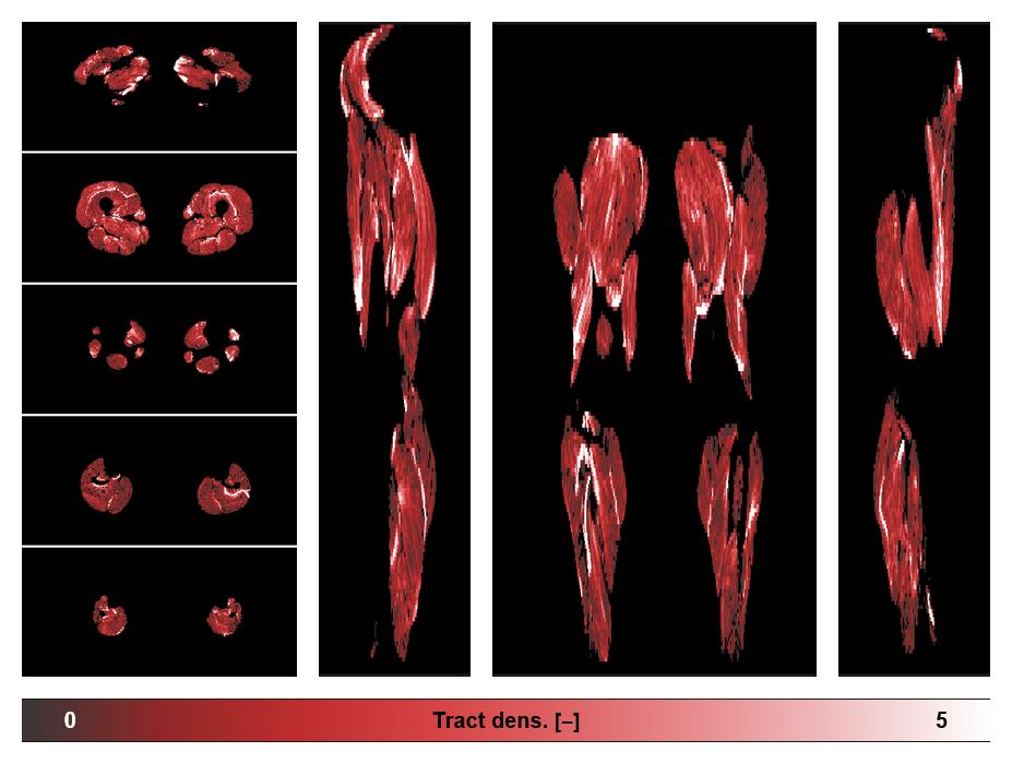Muscle fiber tract density map based on whole leg DTI based fiber tractography.