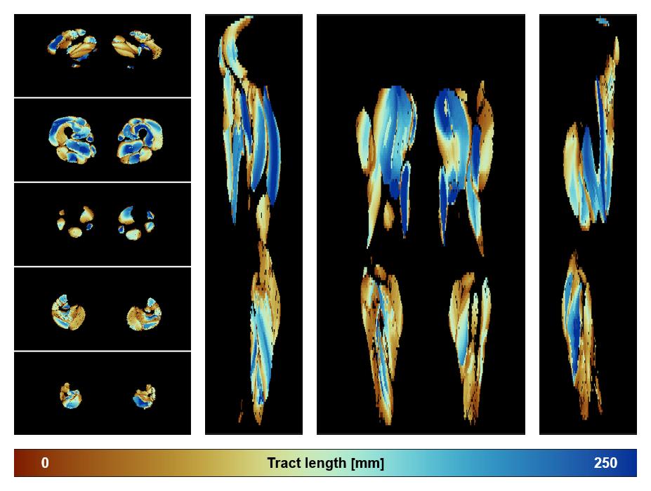 Muscle fiber tract length map based on whole leg DTI based fiber tractography.