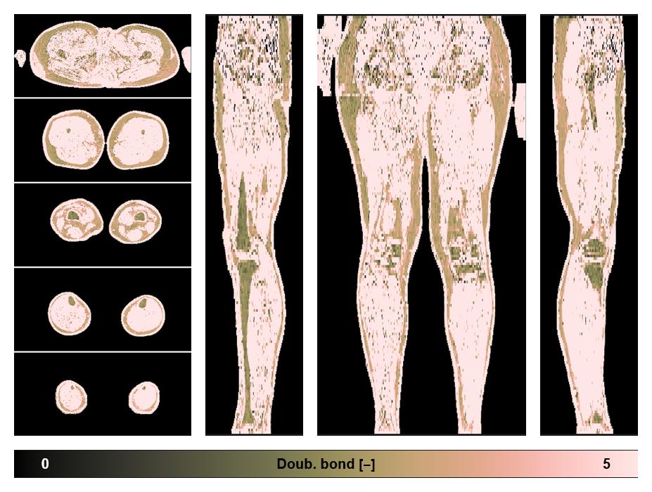 Number of double bonds in subcutanious fat.