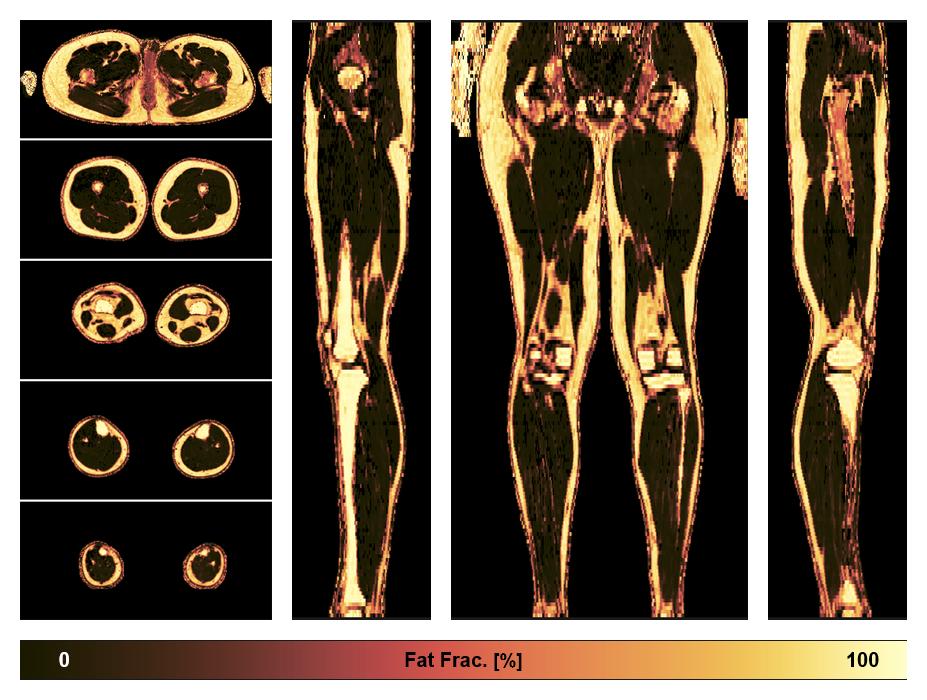 The fat fraction of the lower extremity obtained from the dixon reconstruction for muscle water fat quantification.