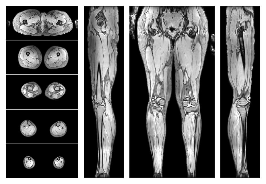 The out-phase image of the dixon reconstruction for water fat quantification.