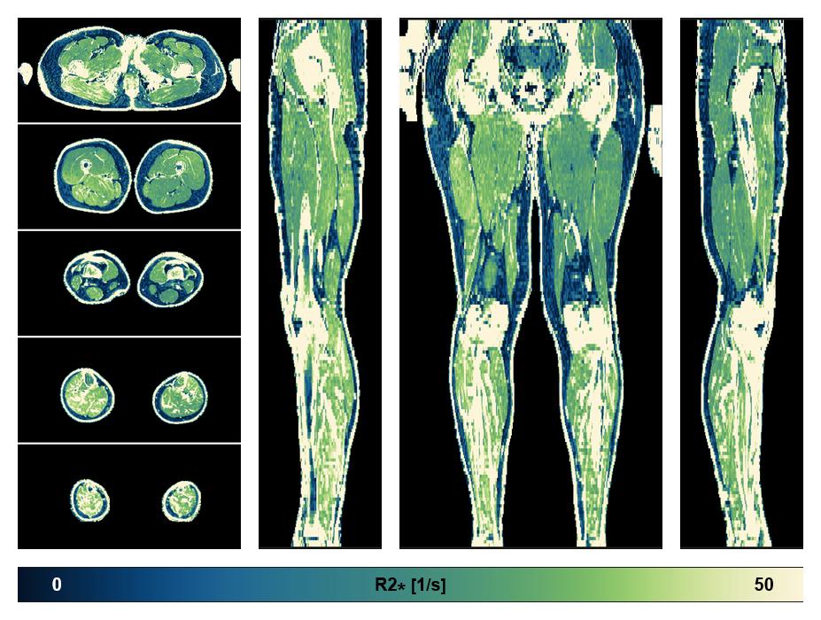 The R2 star relaxation time of the lower extremity obtained from the dixon reconstruction for muscle water fat quantification.