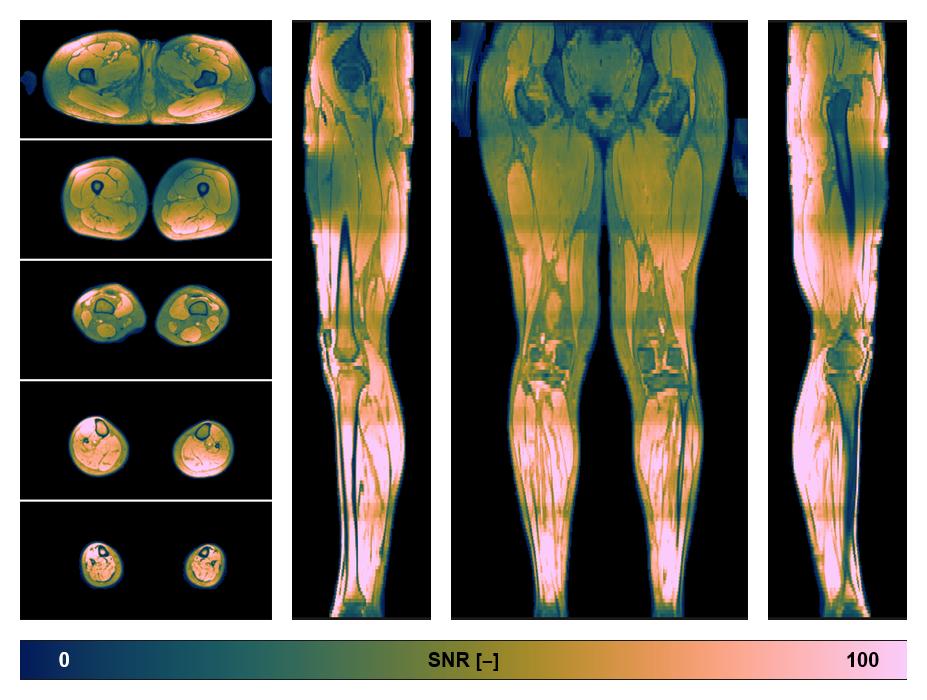 The SNR distribution of the dixon data.