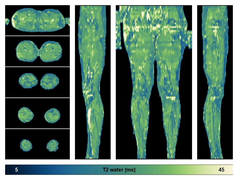 The water only T2 relaxation time of the lower extremity obtained from multi echo spin echo t2 mapping with EPG based reconstruction.