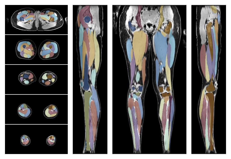 Overlay of automated muscle segmentation labels on dixon water image.