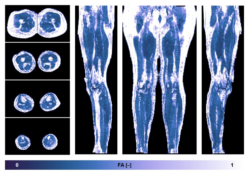 IVIM corrected whole leg muscle fractional anisotropy obtained from diffusion tensor imaging.