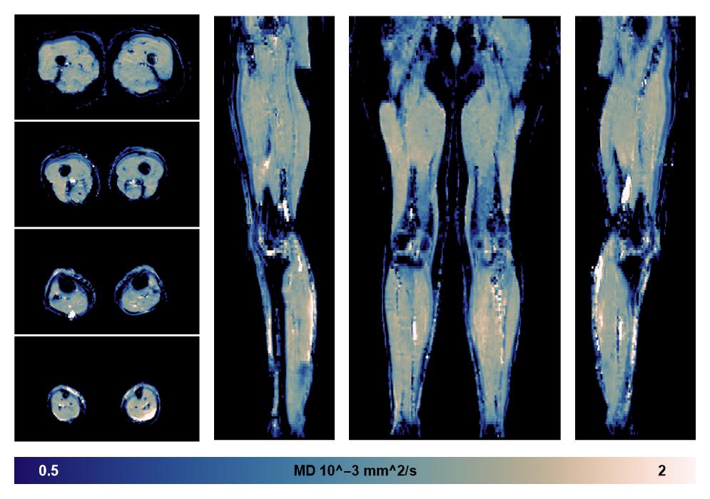 IVIM corrected whole leg muscle mean diffusivity obtained from diffusion tensor imaging.