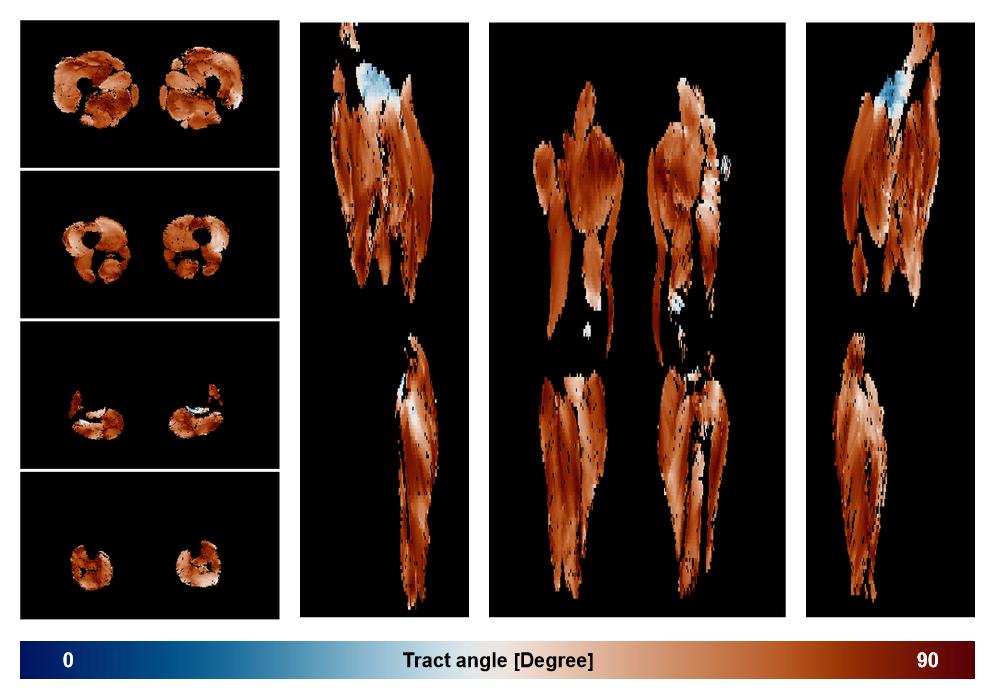 Muscle fiber tract angle map based on whole leg DTI based fiber tractography.