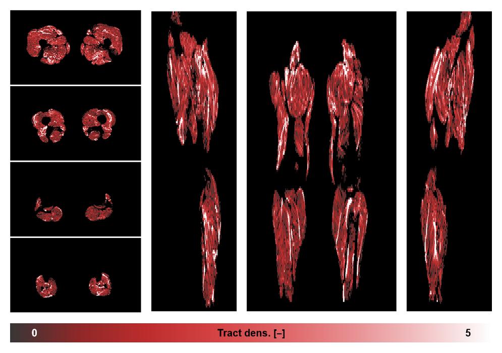Muscle fiber tract density map based on whole leg DTI based fiber tractography.