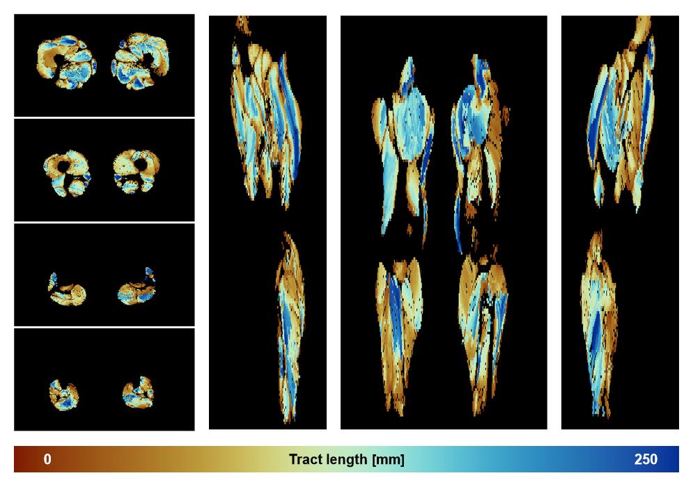 Muscle fiber tract length map based on whole leg DTI based fiber tractography.