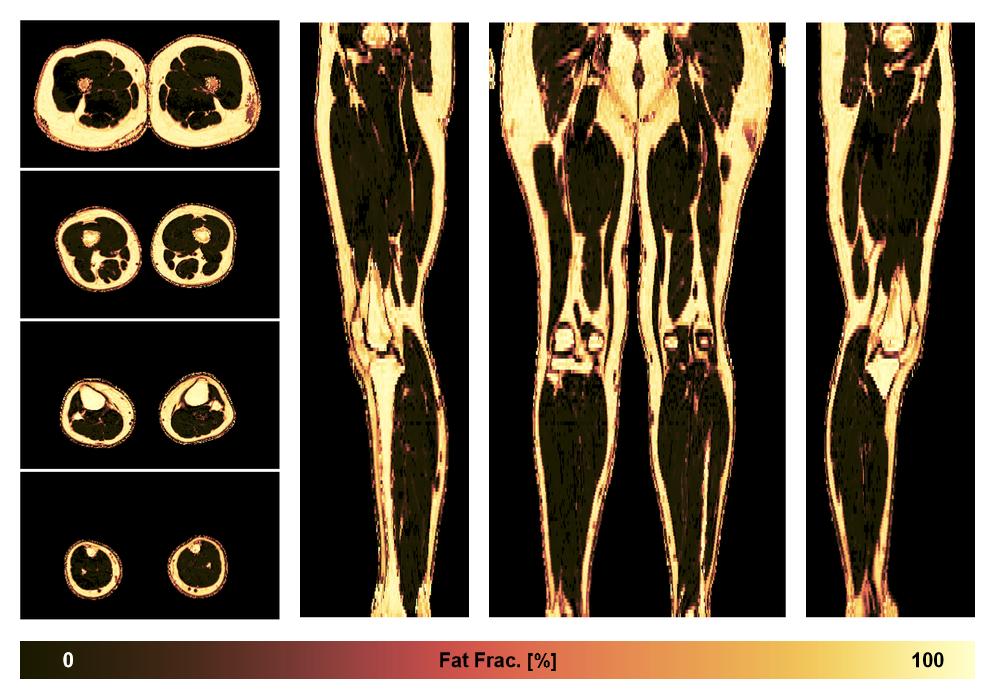 The fat fraction of the lower extremity obtained from the dixon reconstruction for muscle water fat quantification.