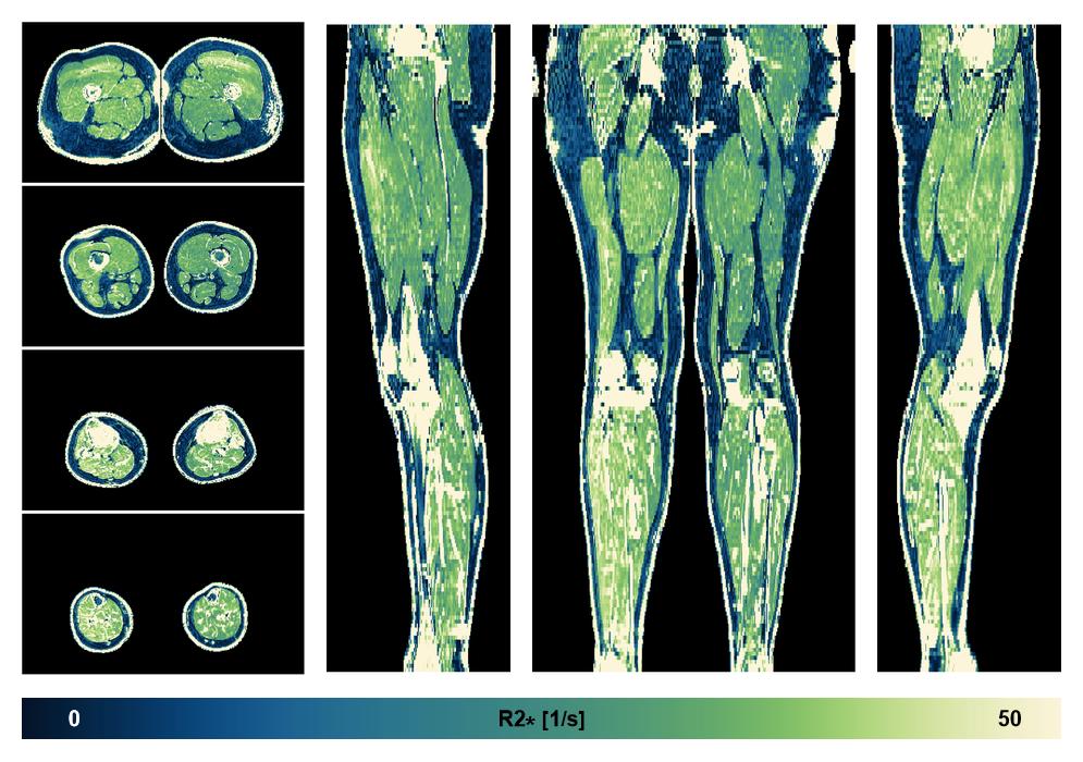 The R2 star relaxation time of the lower extremity obtained from the dixon reconstruction for muscle water fat quantification.