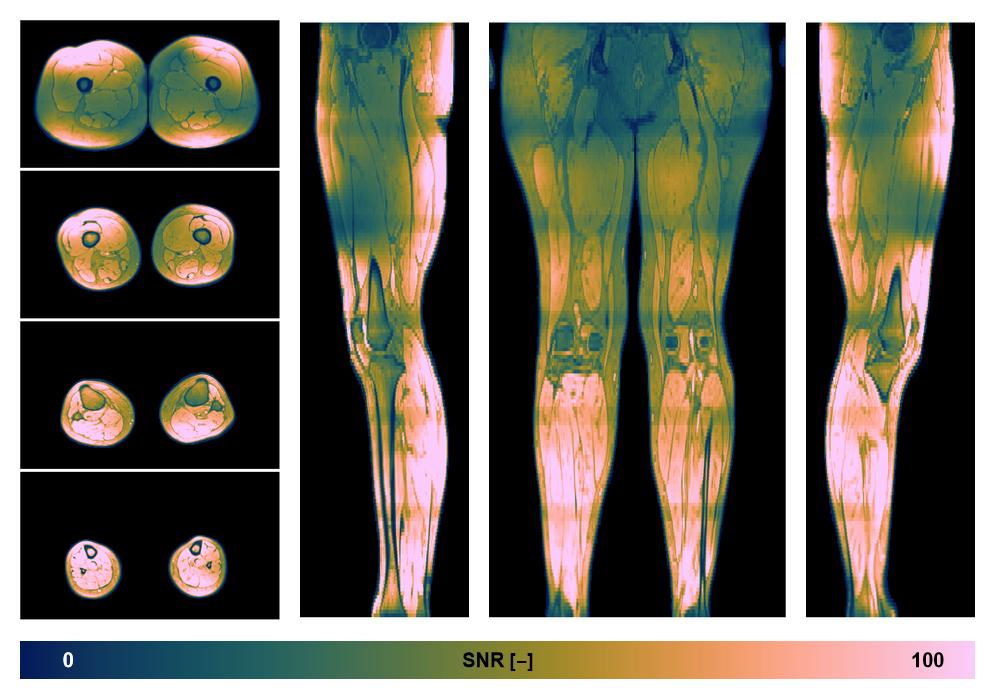 The SNR distribution of the dixon data.