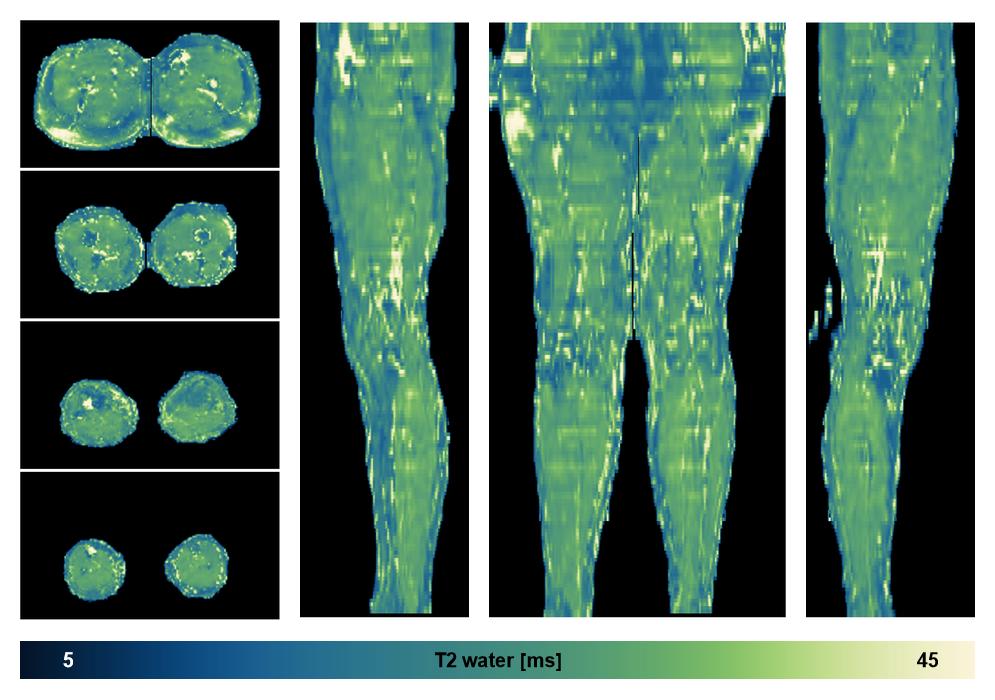 The water only T2 relaxation time of the lower extremity obtained from multi echo spin echo t2 mapping with EPG based reconstruction.