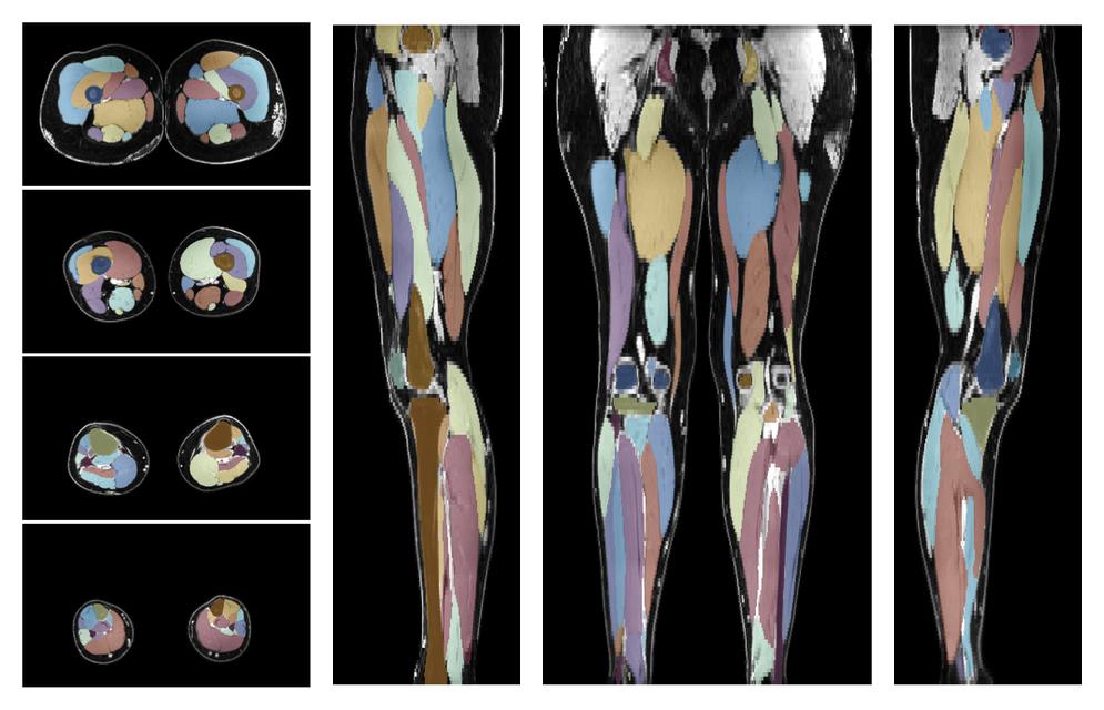 Overlay of automated muscle segmentation labels on dixon water image.