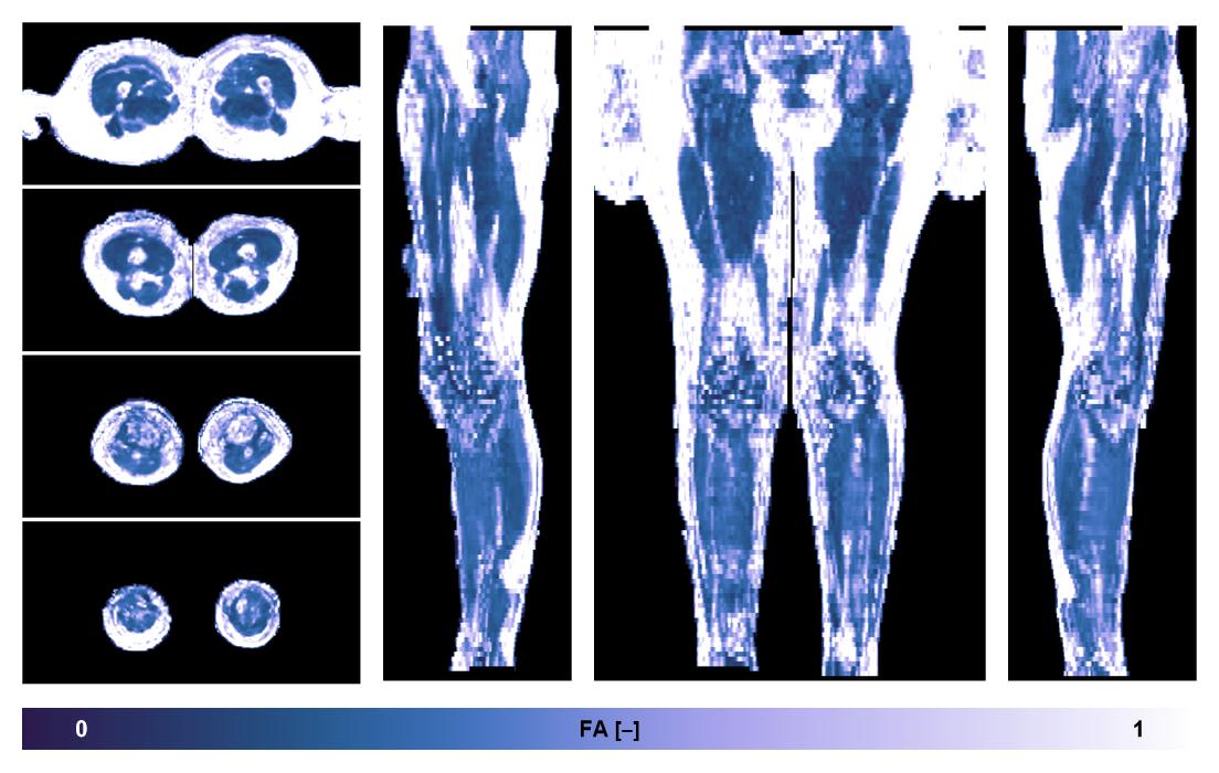 IVIM corrected whole leg muscle fractional anisotropy obtained from diffusion tensor imaging.