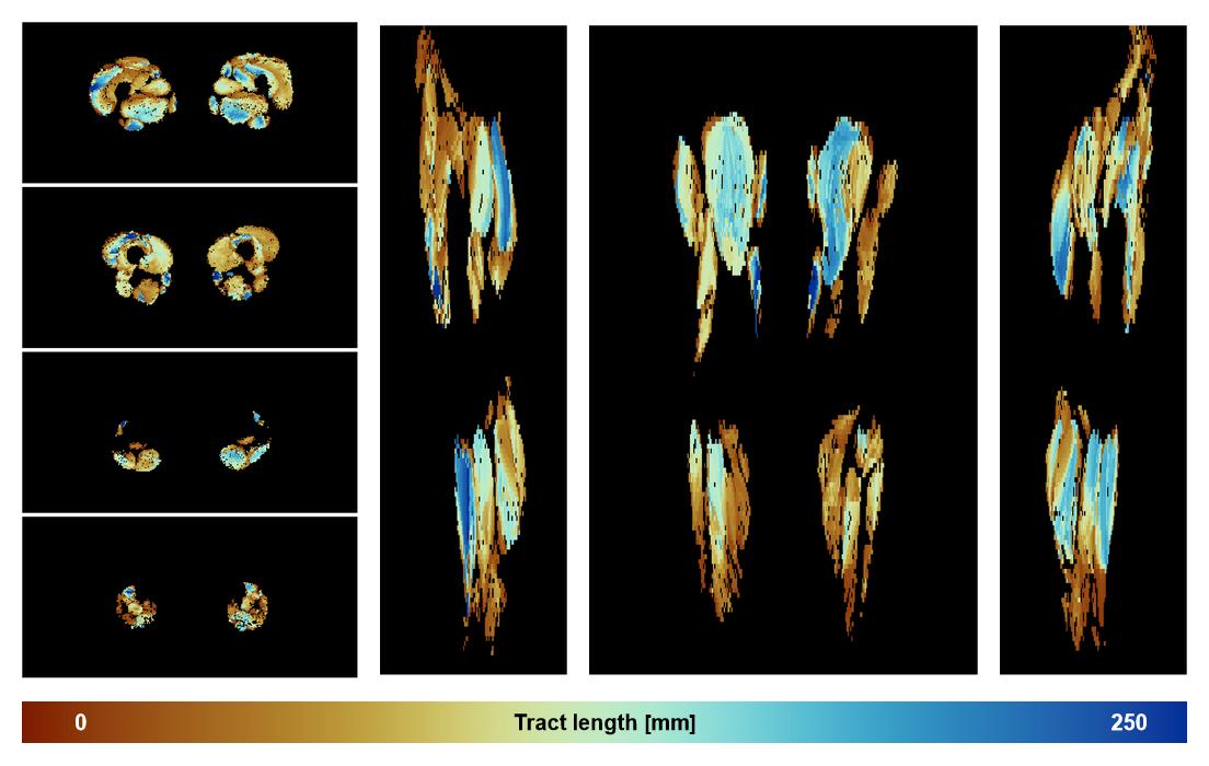 Muscle fiber tract length map based on whole leg DTI based fiber tractography.