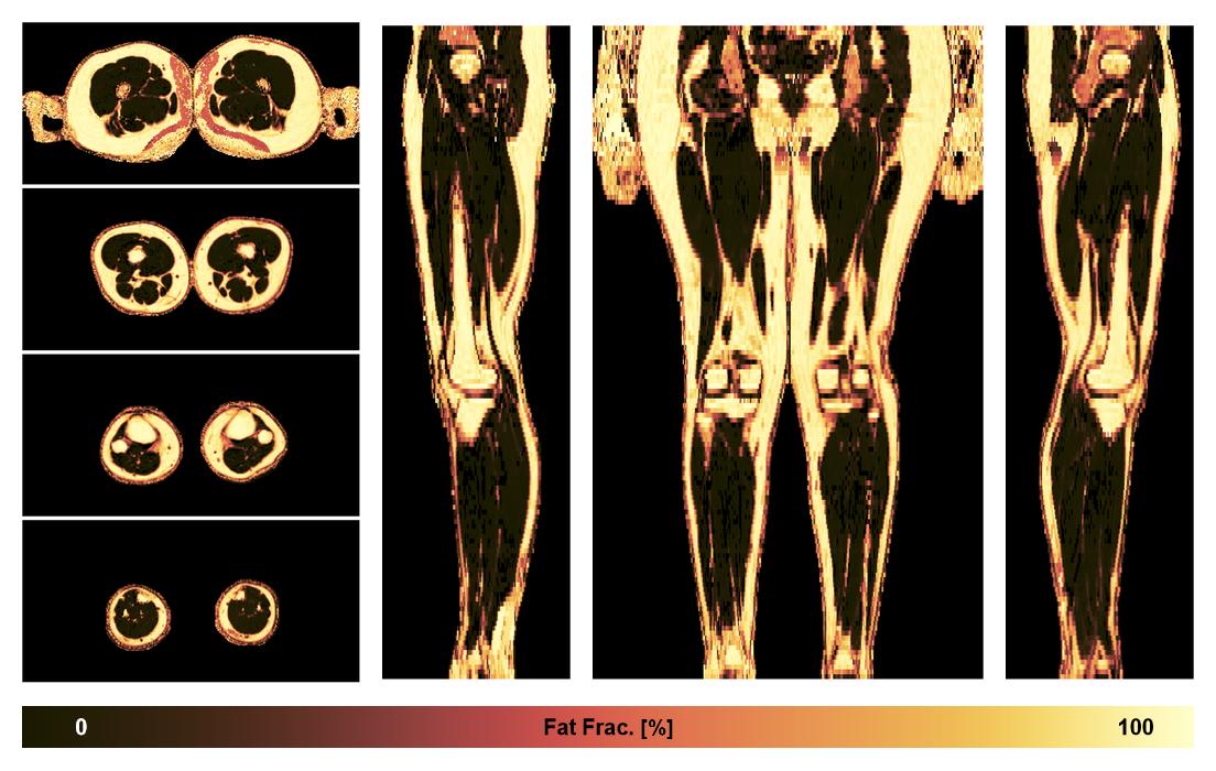 The fat fraction of the lower extremity obtained from the dixon reconstruction for muscle water fat quantification.