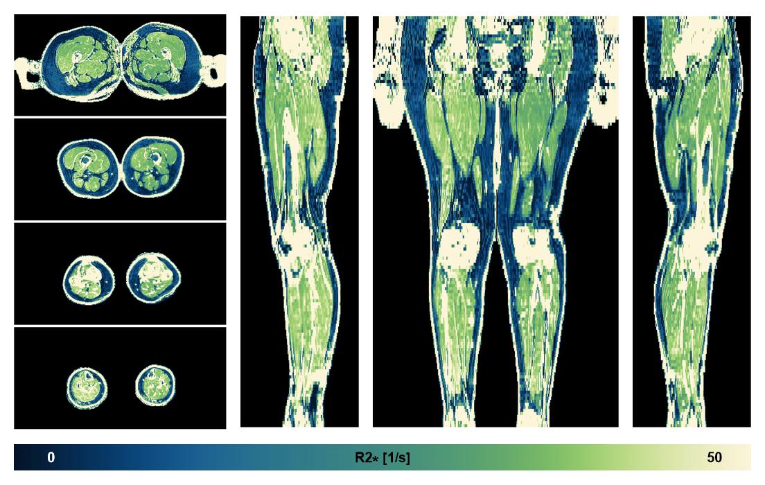 The R2 star relaxation time of the lower extremity obtained from the dixon reconstruction for muscle water fat quantification.