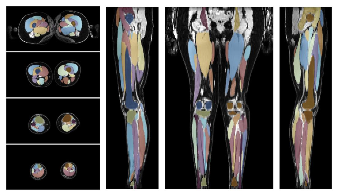 Overlay of automated muscle segmentation labels on dixon water image.