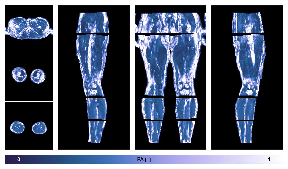 IVIM corrected whole leg muscle fractional anisotropy obtained from diffusion tensor imaging.