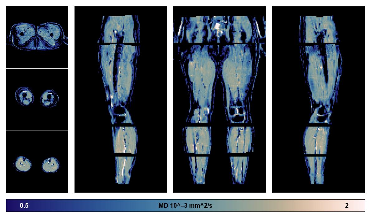 IVIM corrected whole leg muscle mean diffusivity obtained from diffusion tensor imaging.