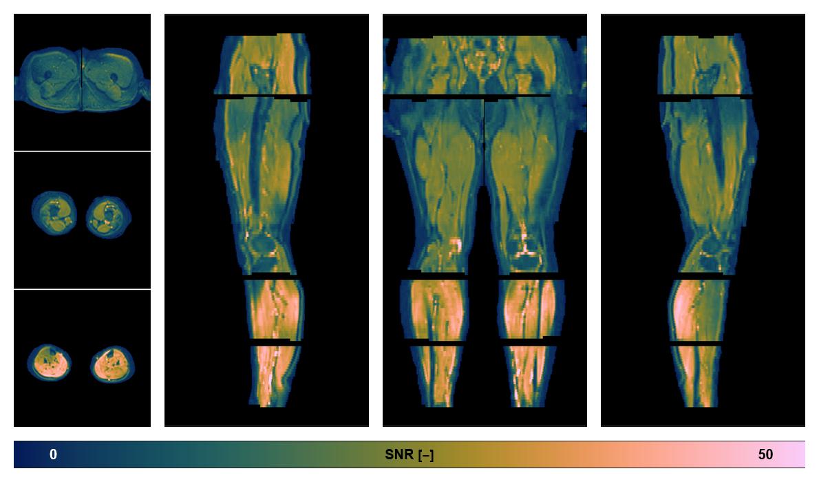 SNR distribution of the unweighted diffusion data.