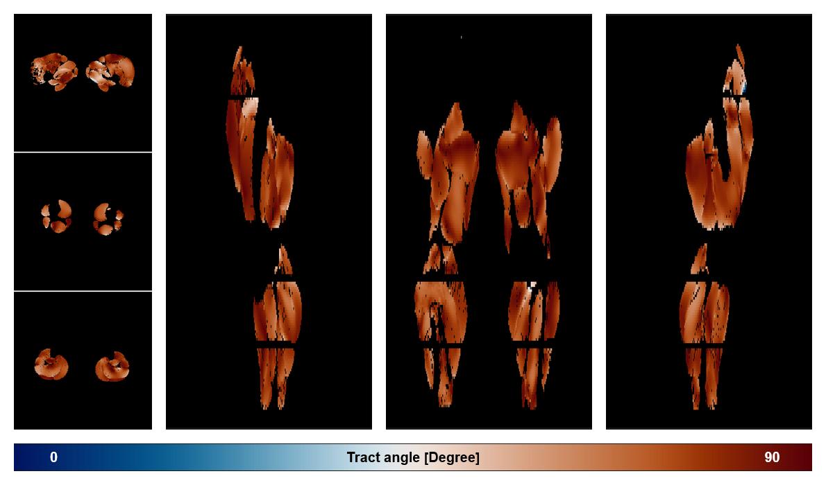 Muscle fiber tract angle map based on whole leg DTI based fiber tractography.