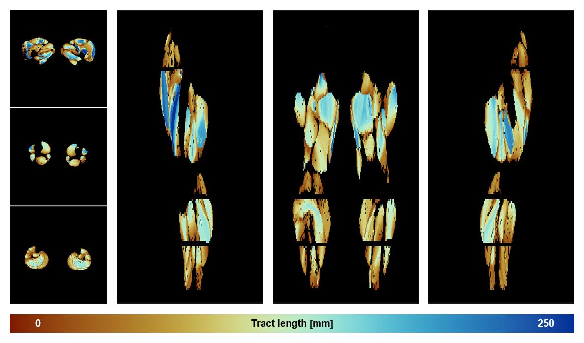 Muscle fiber tract length map based on whole leg DTI based fiber tractography.