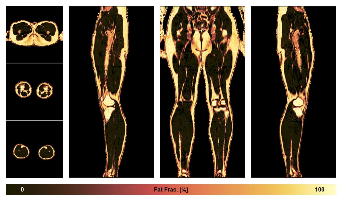 The fat fraction of the lower extremity obtained from the dixon reconstruction for muscle water fat quantification.