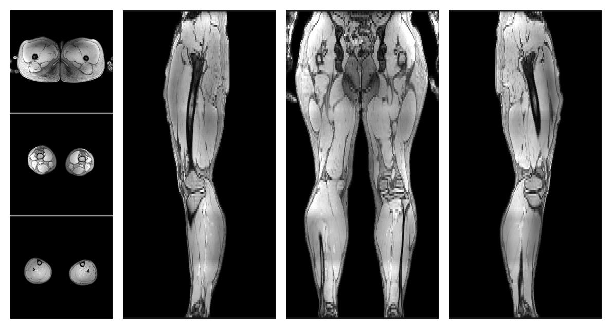 The out-phase image of the dixon reconstruction for water fat quantification.