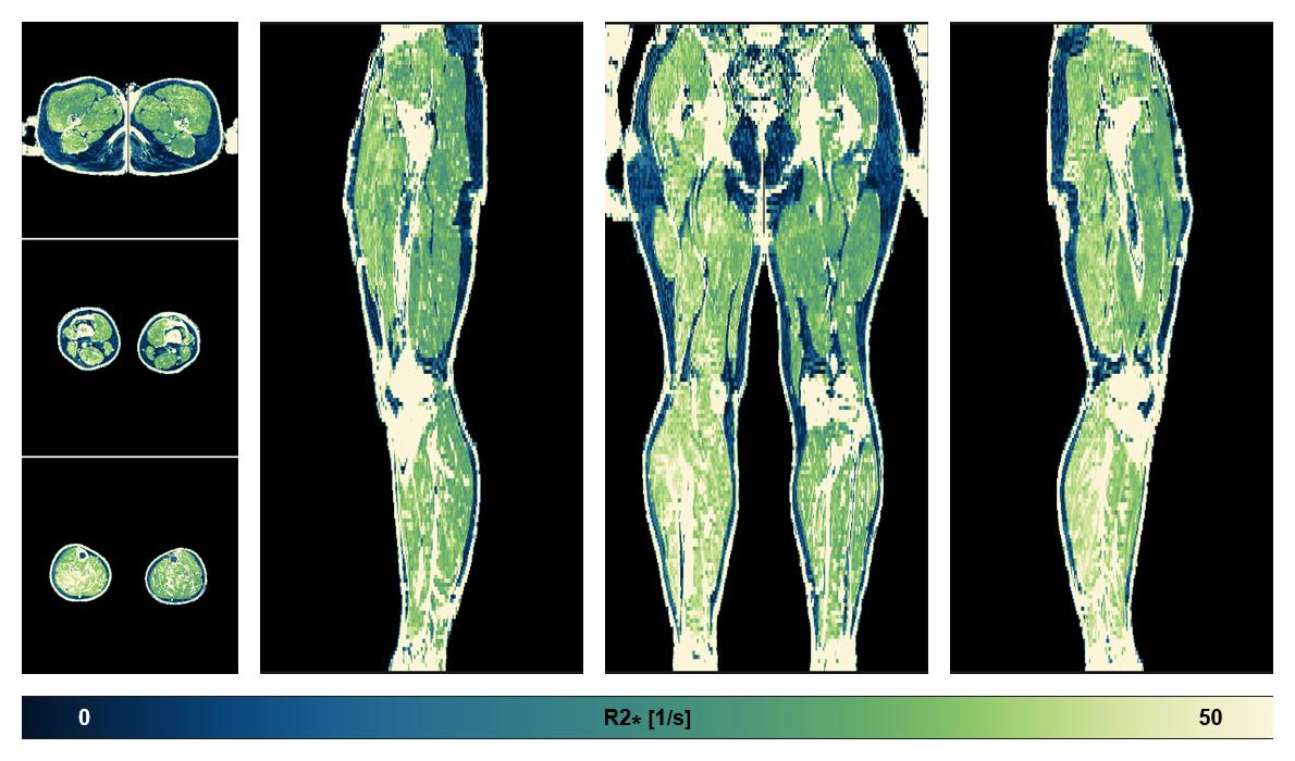 The R2 star relaxation time of the lower extremity obtained from the dixon reconstruction for muscle water fat quantification.