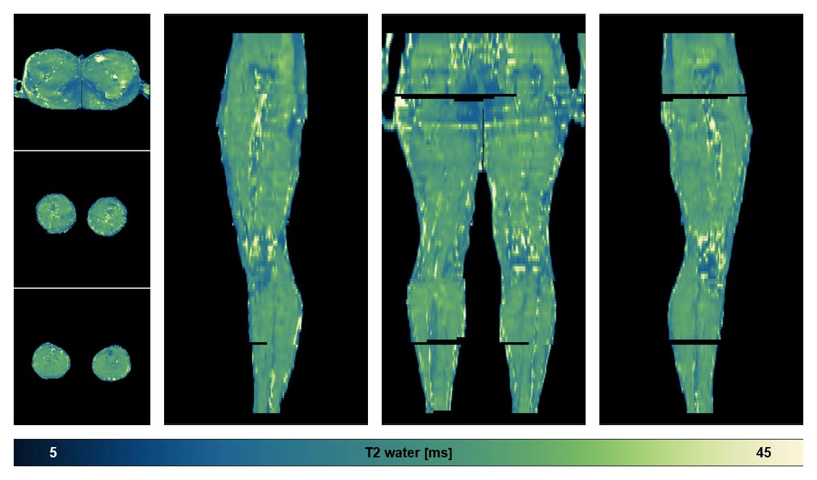 The water only T2 relaxation time of the lower extremity obtained from multi echo spin echo t2 mapping with EPG based reconstruction.
