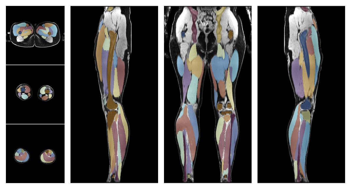 Overlay of automated muscle segmentation labels on dixon water image.