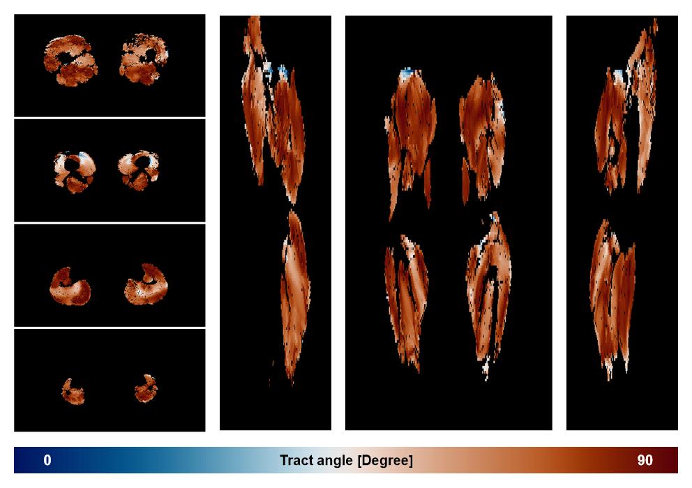 Muscle fiber tract angle map based on whole leg DTI based fiber tractography.